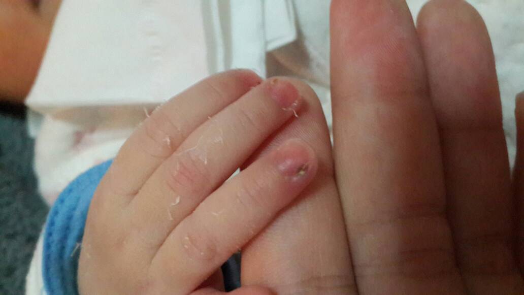 宝宝手指这样会自己好起来吗?还是要去医院看下?