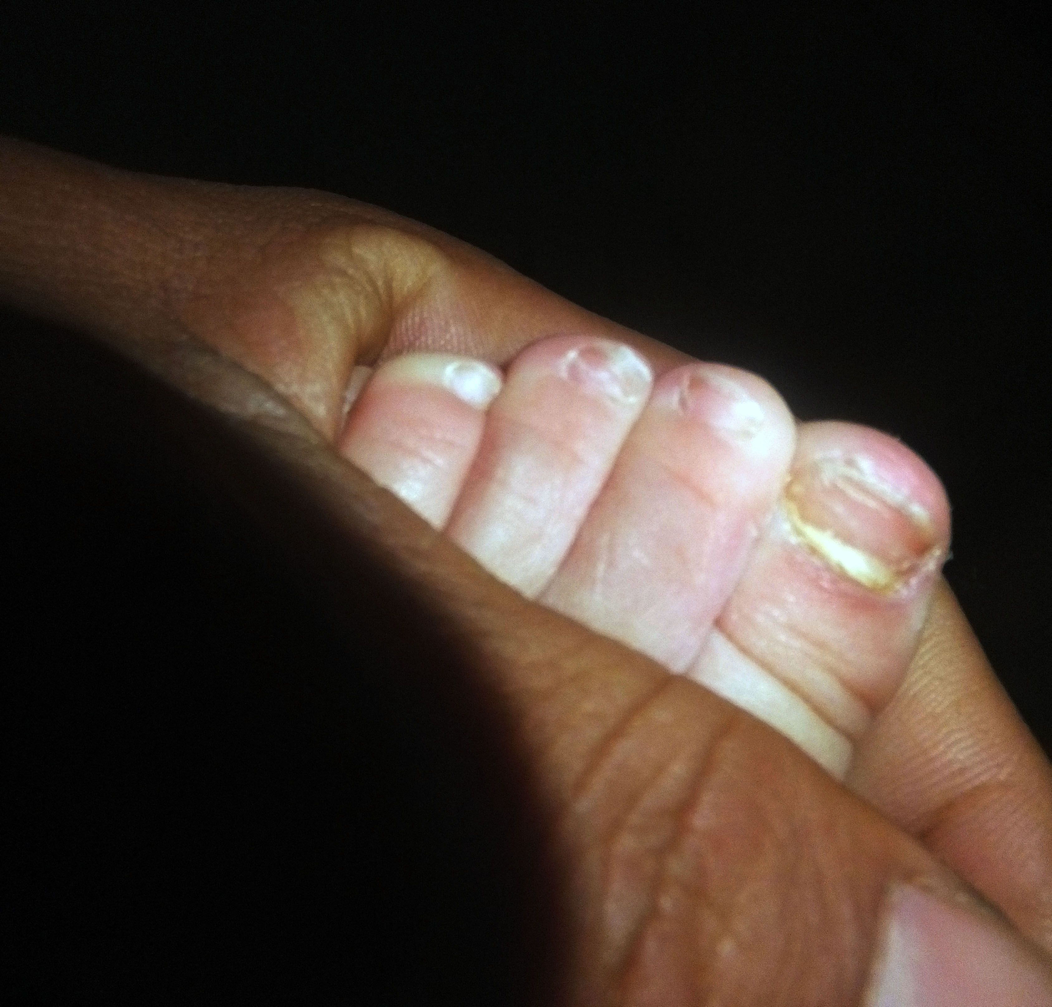 我家宝宝21个月了今天发现左脚拇指有灰指甲,这么小的就有灰指甲该用