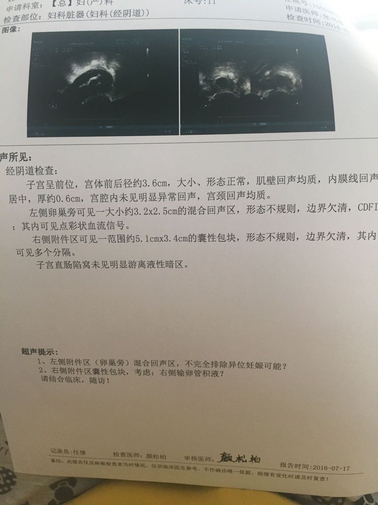 宫外孕保守治疗,查阴超说左侧有3.2×2.