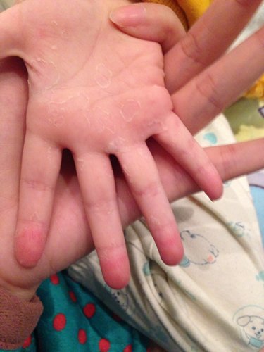 4岁宝宝,手心,手指头大面积蜕皮,不疼,无水泡,偶尔有些痒,指头褪的