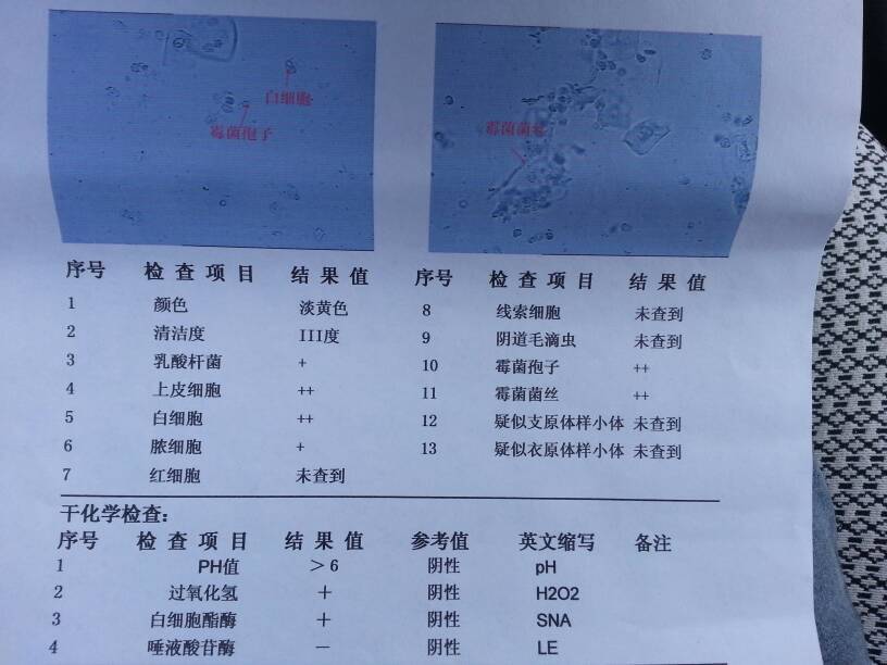 白帶常規檢查結果怎麼看?