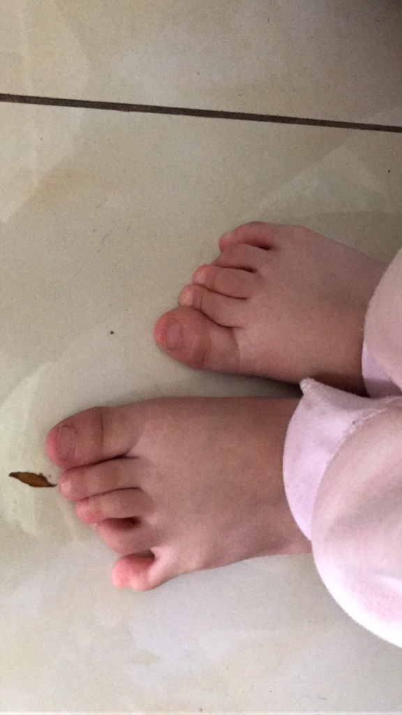 一岁半第四个脚趾被第三个脚趾压 