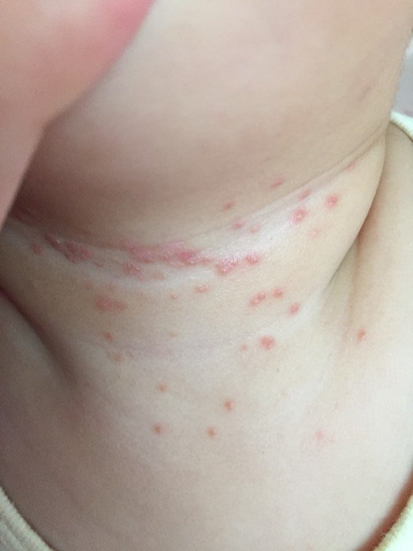 宝宝脖子上长了一颗颗红痘痘是什么