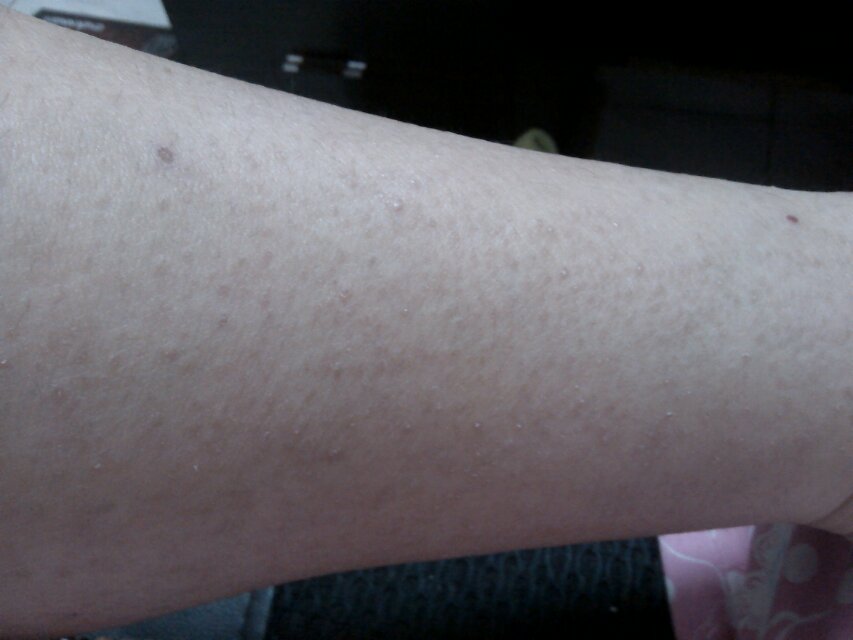 以前皮肤也很痒可是没有起那么多疙瘩近一个月起了好多小的疙瘩好痒