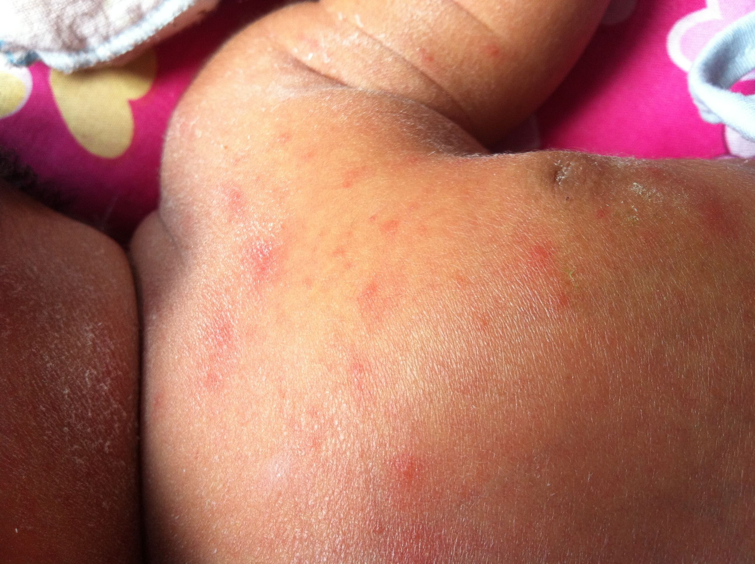 足月顺产男婴,生后第二天发现肩部后背有类似蚊虫叮咬的红色丘疹,数量