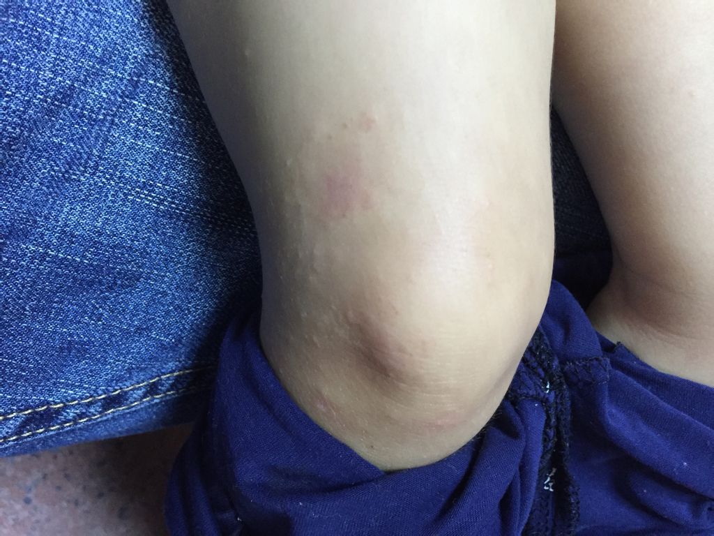 不怎么痒,有一个月了,一开始就膝盖上有一个一角硬币大的疙瘩