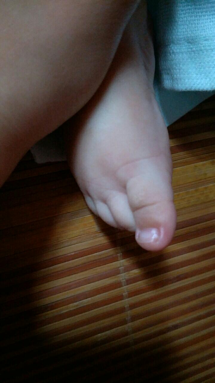 请问有宝妈知道,小孩的脚指头的指甲边红肿了,里面好像有脓,有方法治