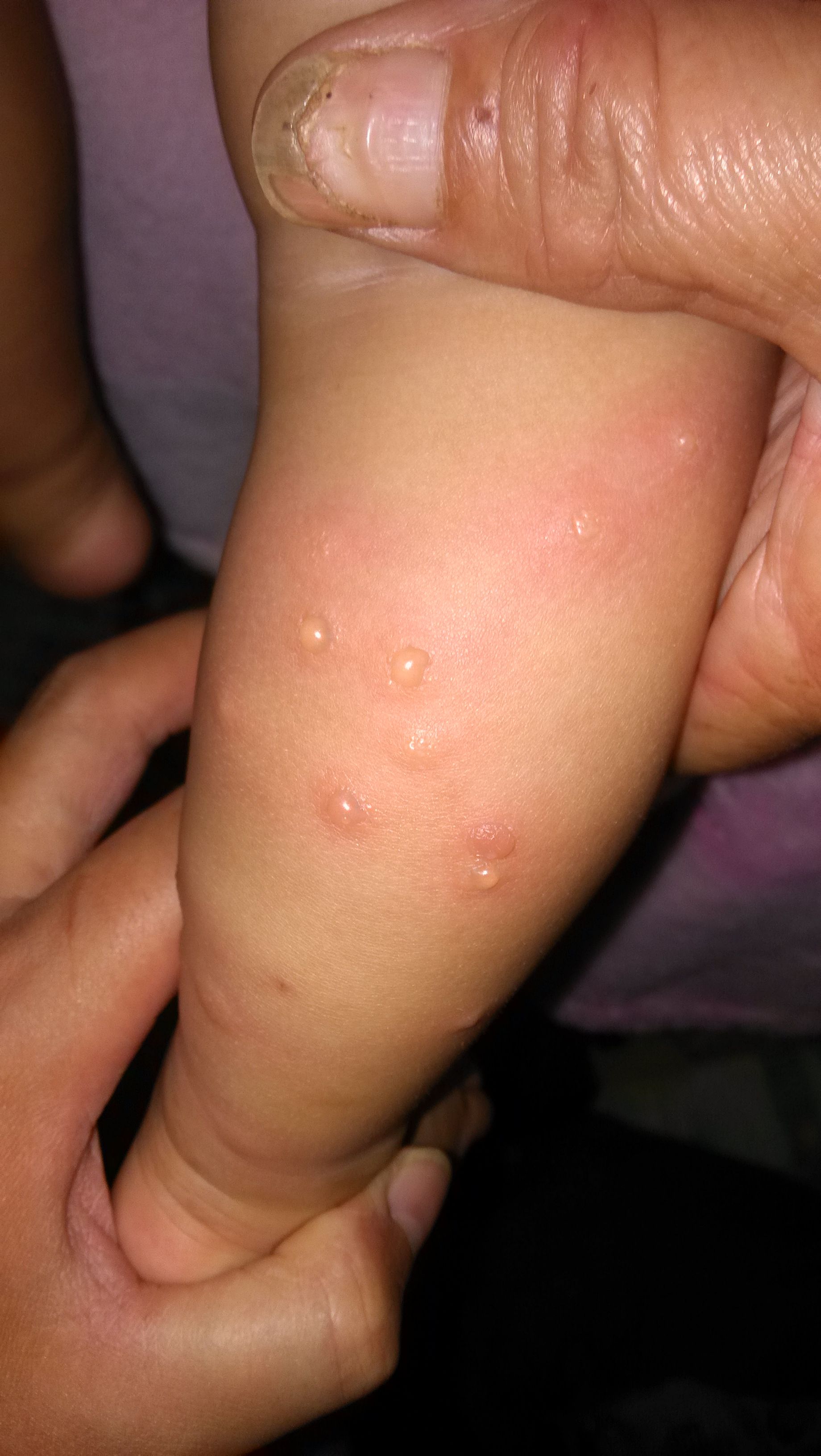 求求大夫们告诉我宝宝身上起的红疹是什么啊?