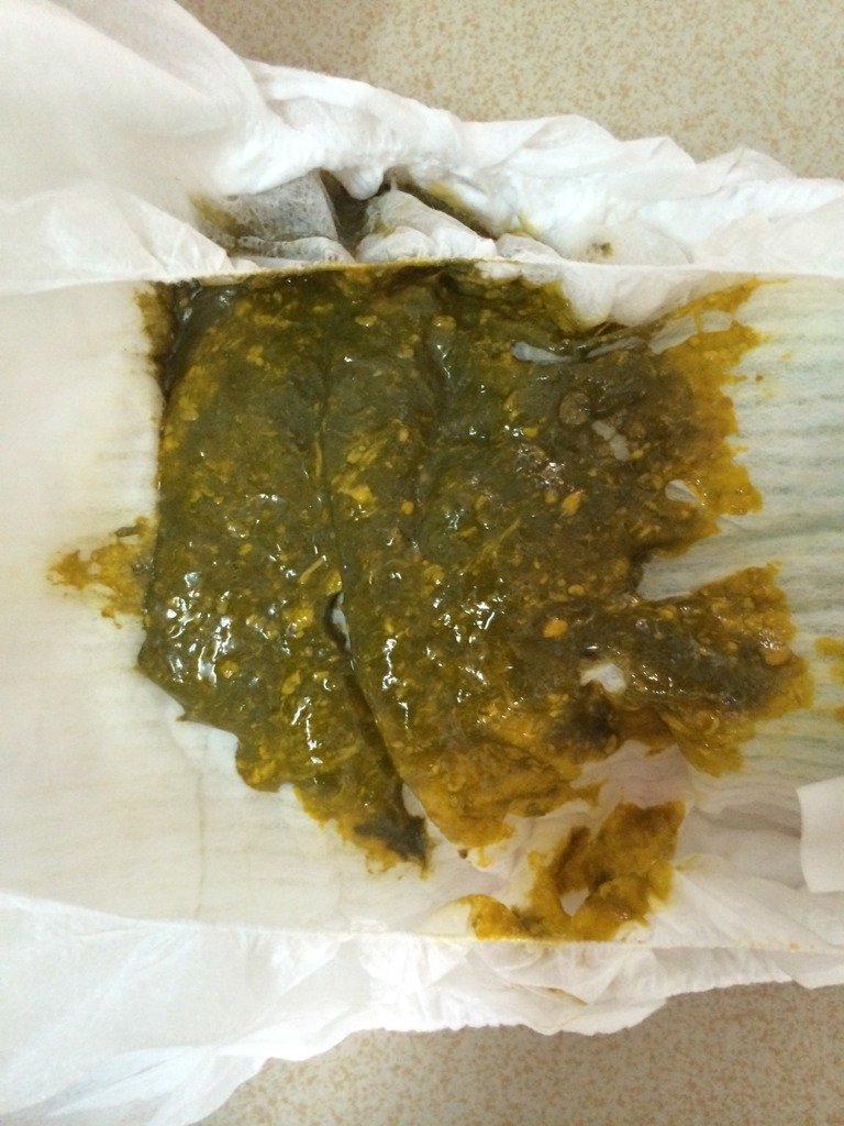 宝宝大便这样是消化不良吗?母乳牛奶都吃,宝宝85天