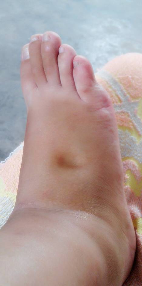 脚丫子肿成这样要不要紧啊