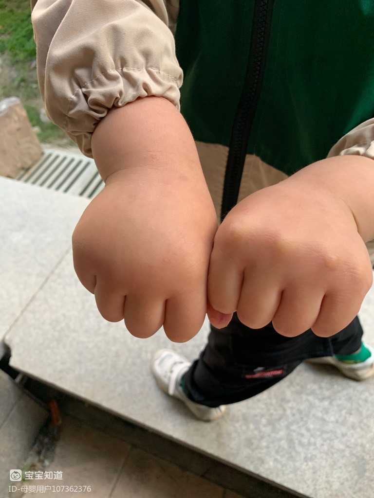 宝宝手一只肥一只瘦