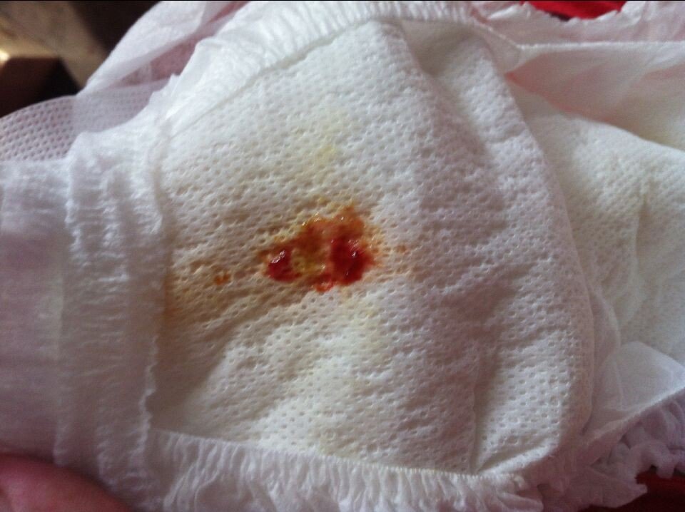 宝宝1个月大,大便像果酱 是怎么回事?谢谢