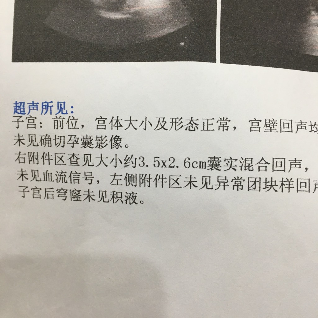 剛懷孕有褐色分泌物會是宮外孕嗎?