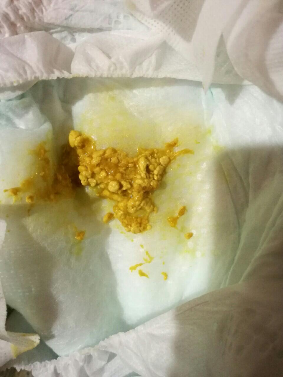 新生儿拉肚子症状,这几个症状可辨别新生宝宝腹泻!