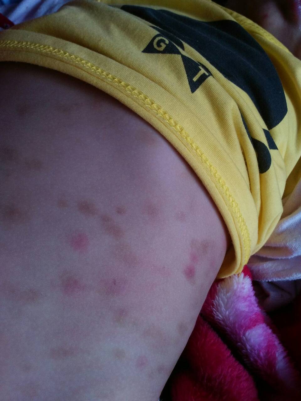 十一个月的宝宝,身上长这种红的,是怎么回事,我给