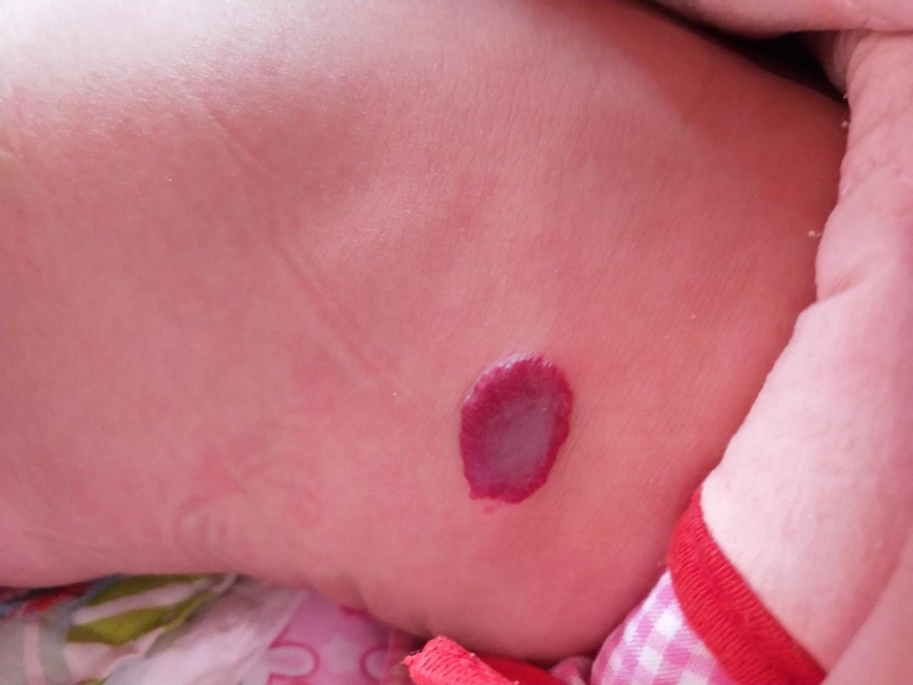 婴幼儿皮下血管瘤图片图片