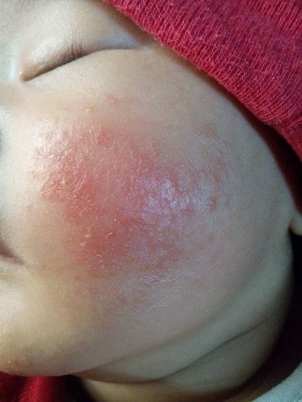 我家宝宝有四十多天,脸上起了红色的豆豆,请问是湿疹,还是什么?