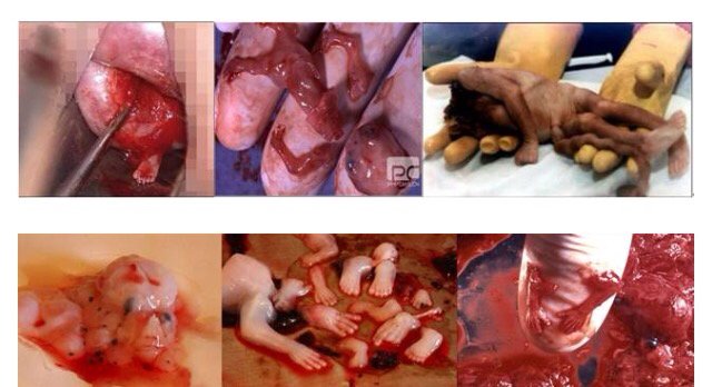 残忍的堕胎过程 大部分的堕胎是在前十二个星期内进行的,胎儿仍然很小