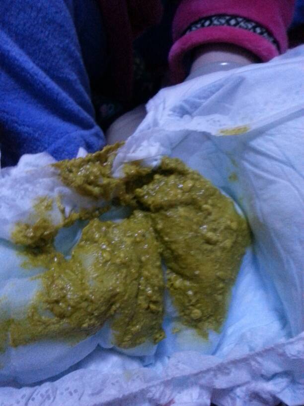 宝宝四个月多,这两天每天拉四次大便,大便如图,请问有问题吗?