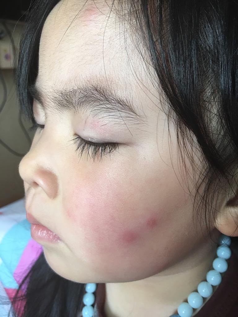 女儿,5岁,没有过敏史,前几天有吃头孢冲剂,因为牙疼,怕炎症引起,所以