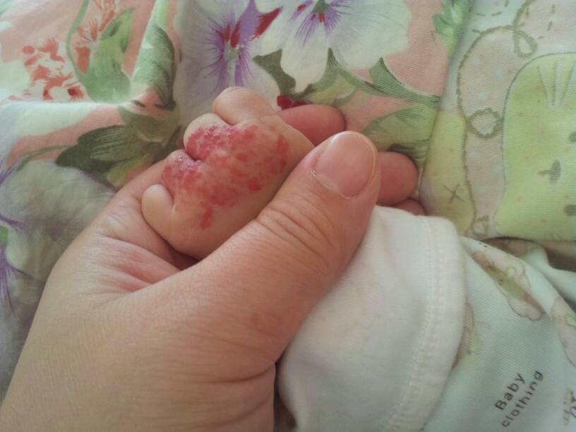 宝宝出生没注意手上有这个血管瘤,手心里也有一块深红发紫色的连到手