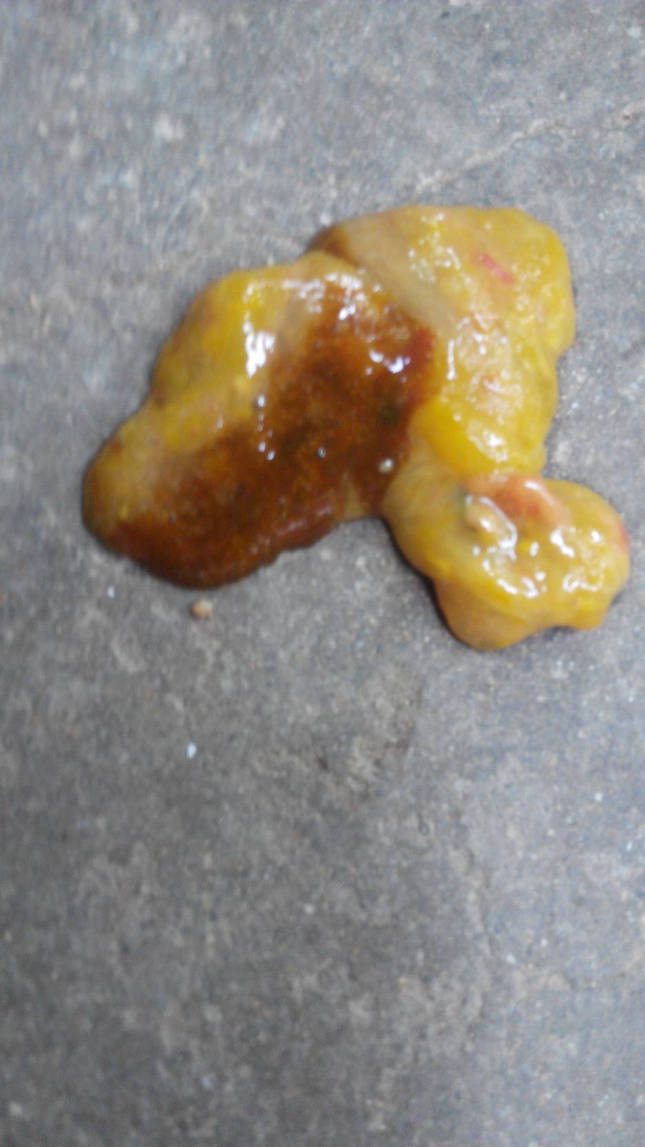 典型阿米巴痢疾粪便图图片