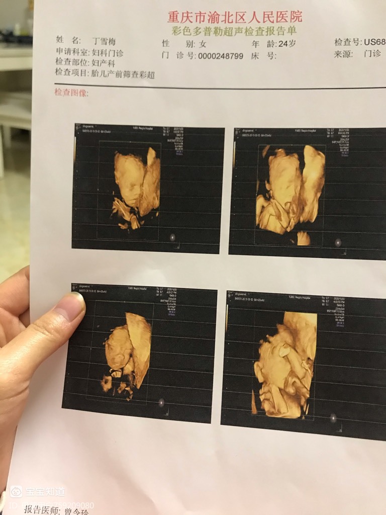 胎儿股骨短图片