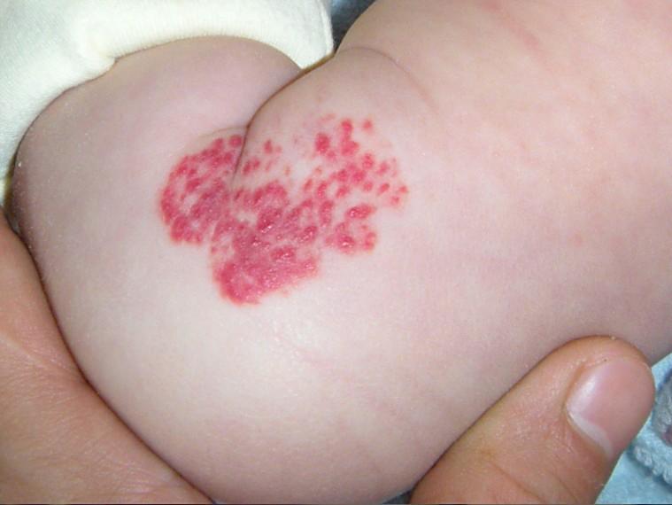 新生儿 腿上红班 - 百度宝宝知道