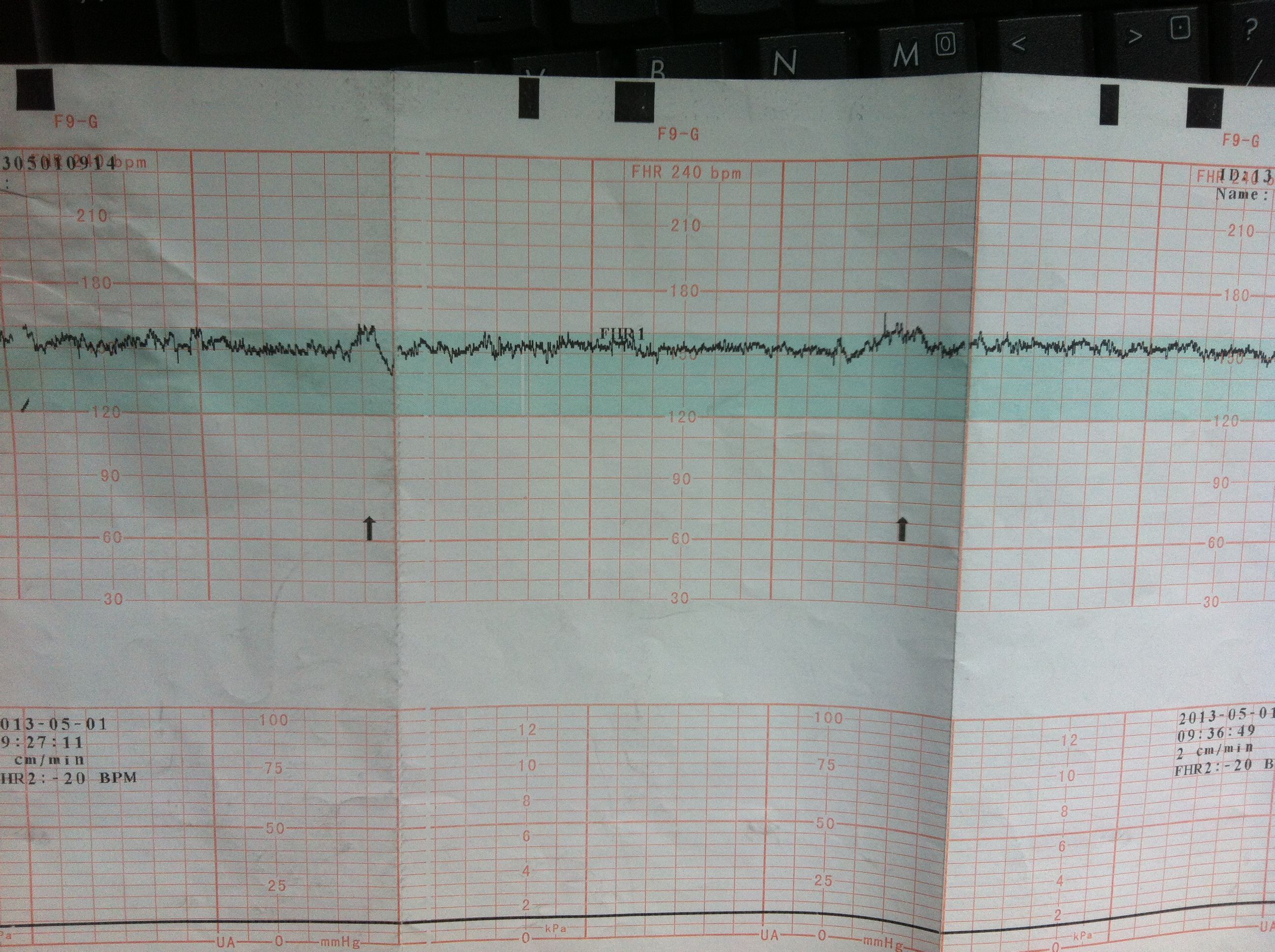 孕32周做胎心监护 求解答