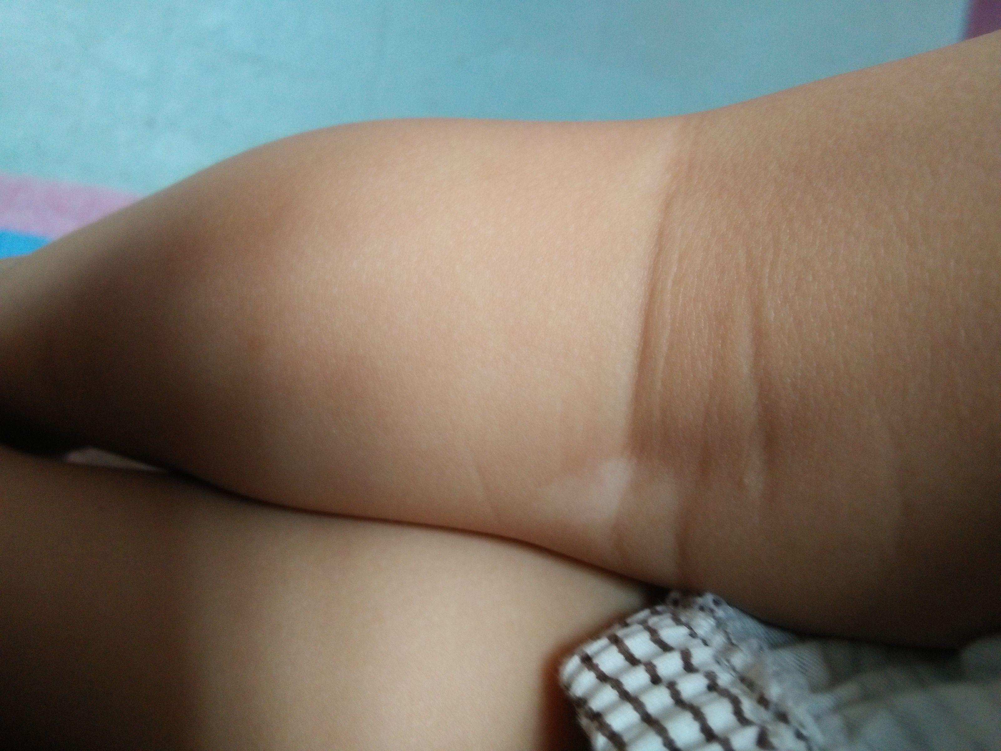 宝宝腿上有一块白斑图图片