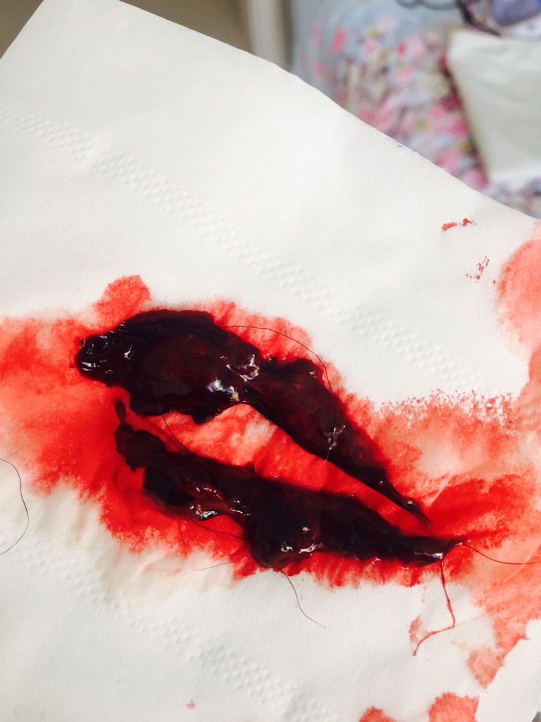 怎么辨别自然流产还是月经?