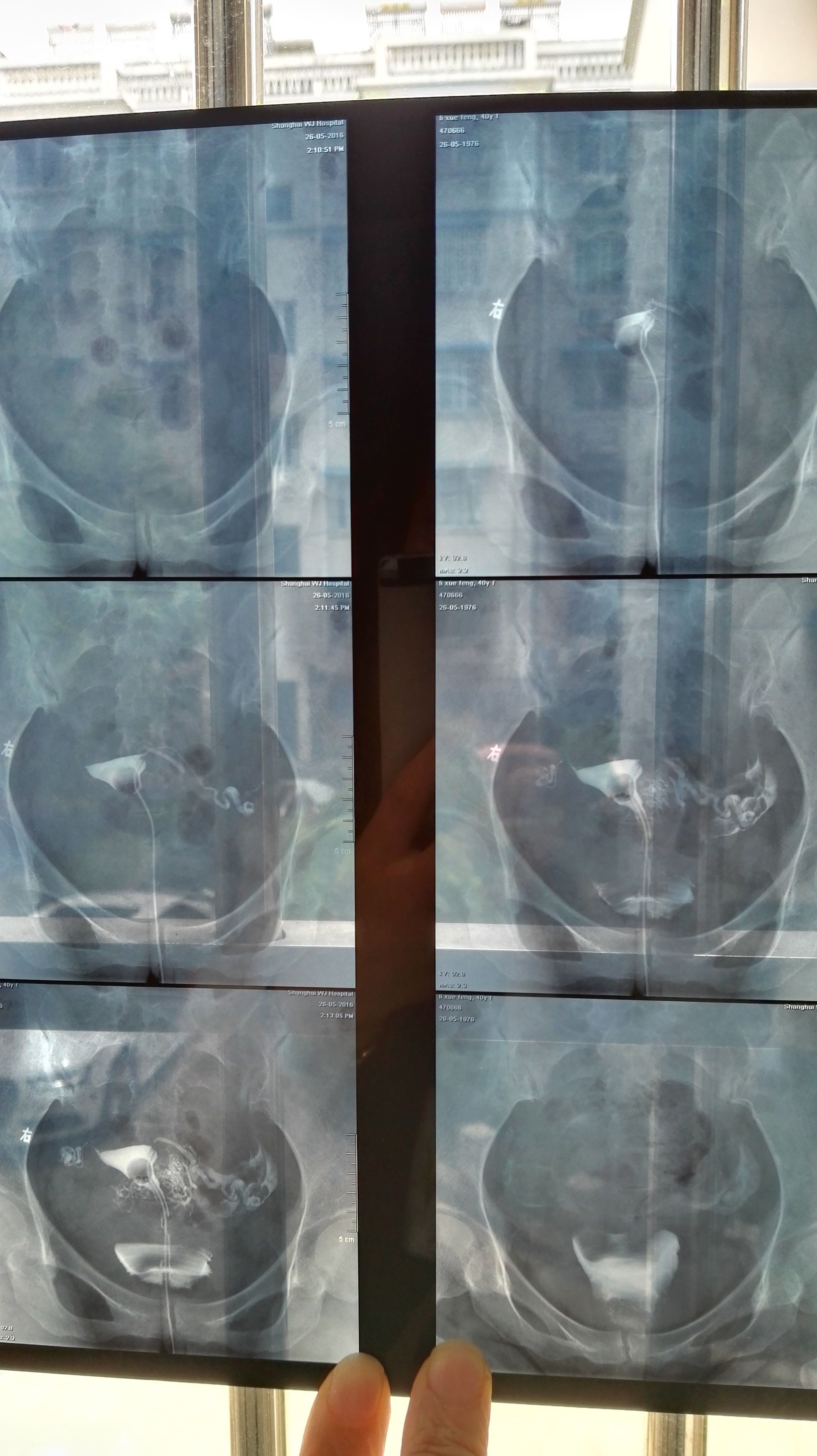 请懂的人帮忙看看这张输卵管造影片子,到底是什么情况 焦急中,坐等