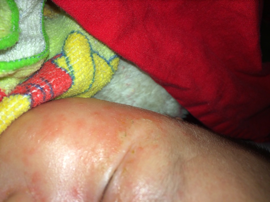 一个月婴儿湿疹图片图片