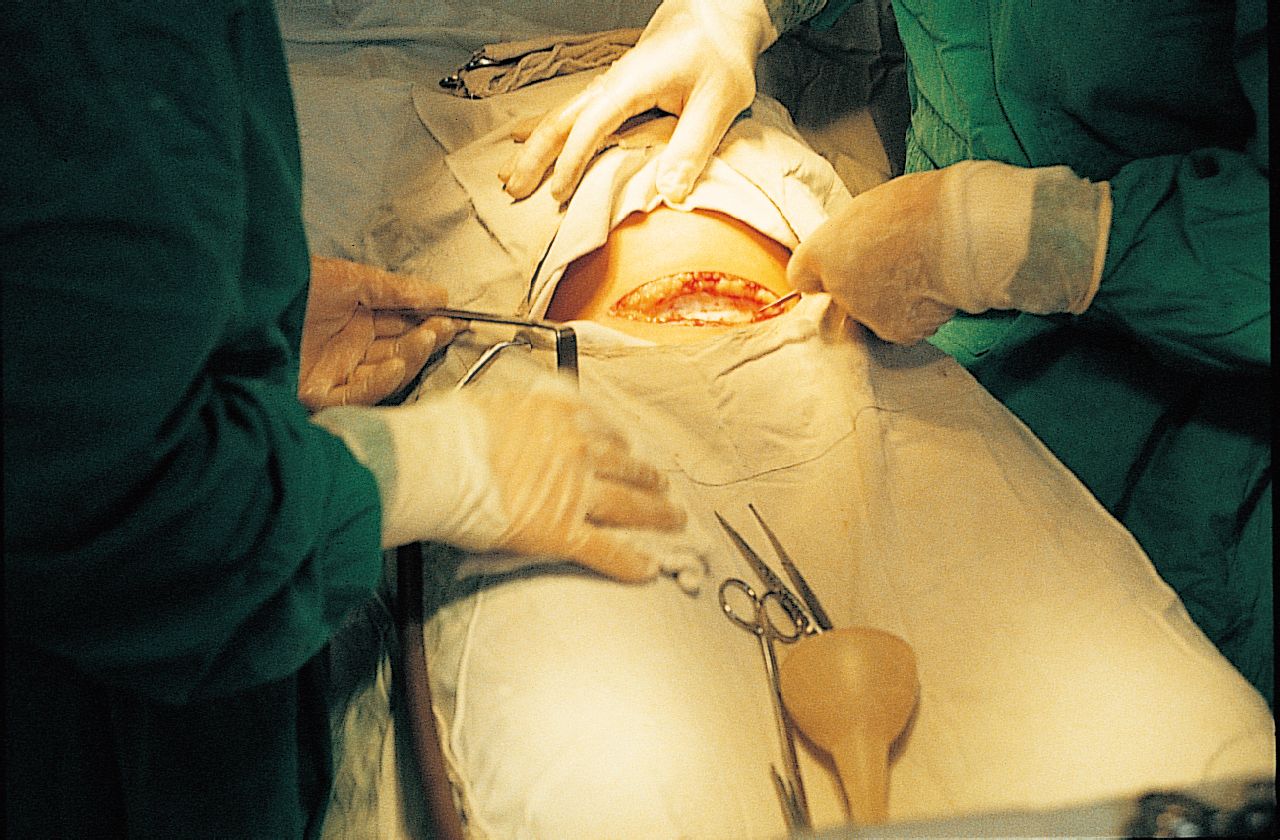 剖腹产手术实拍图片