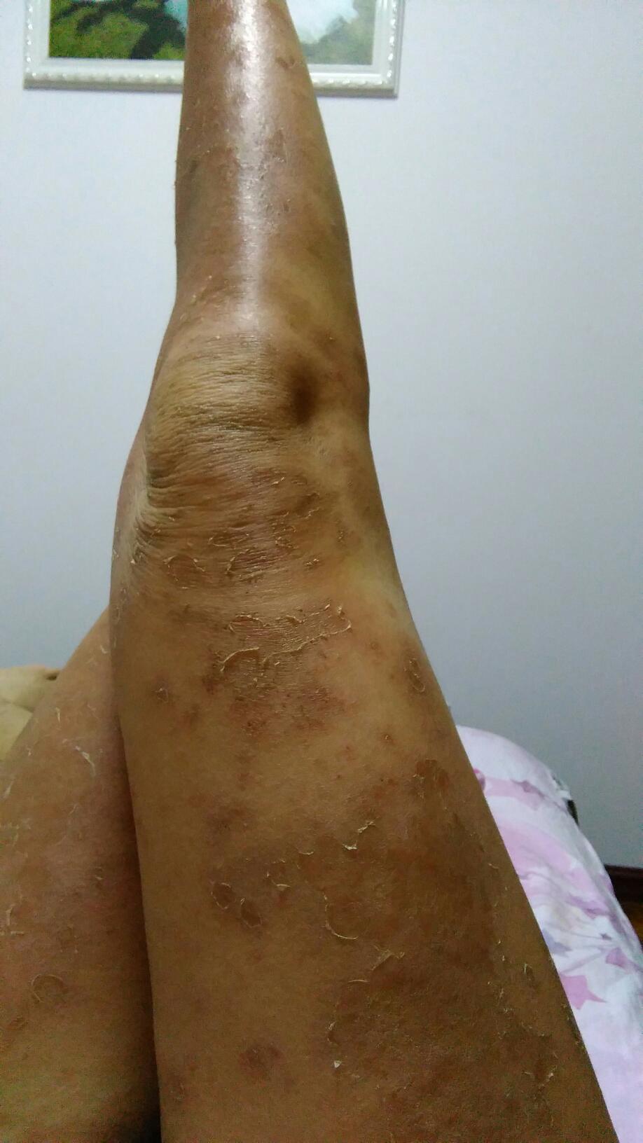 肚皮的湿疹痒死我了!