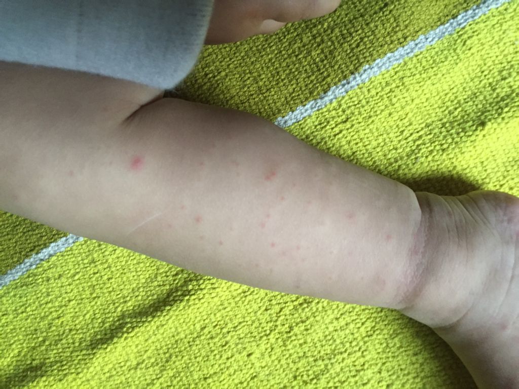 宝宝国庆节得了病毒性感冒,2周左右好了,三天前也就是10月第四周突然