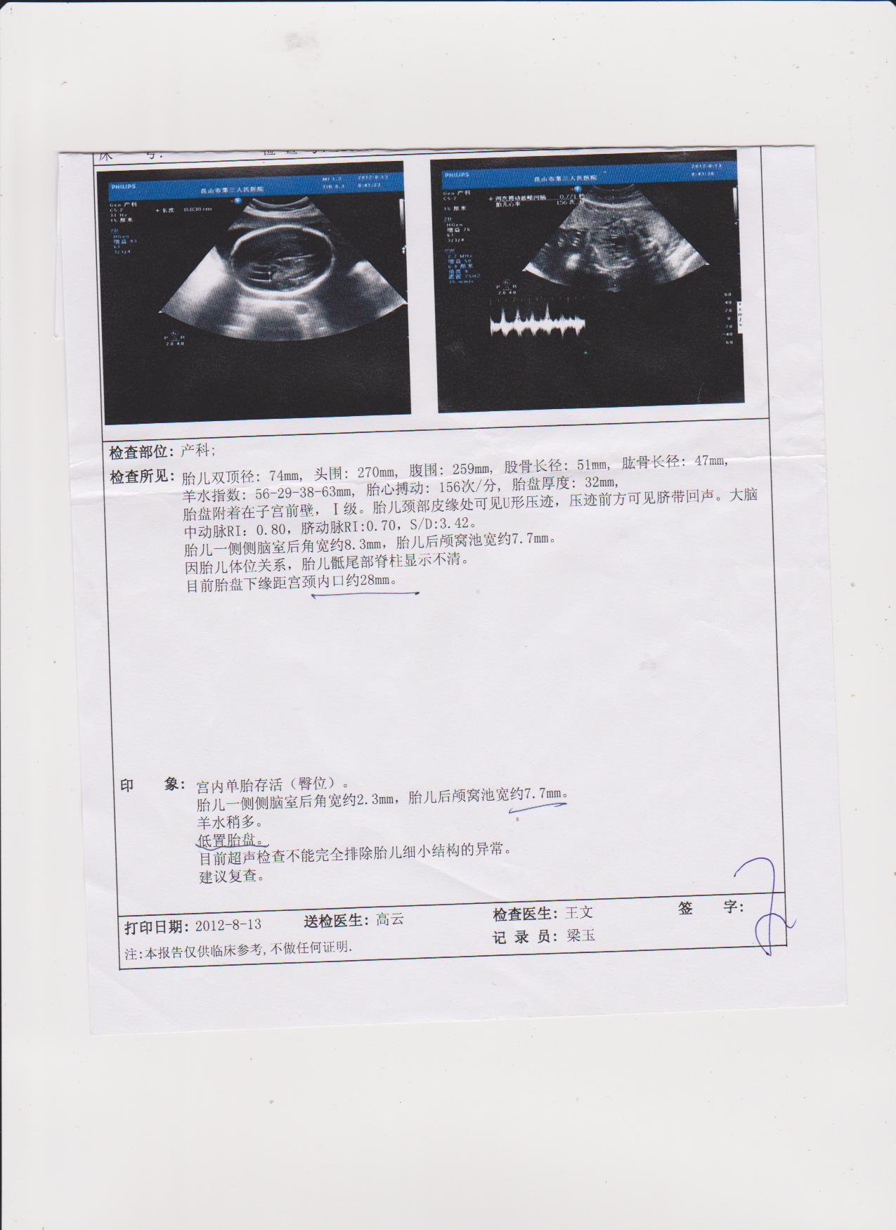 明明白白做超声(十七)：胎盘异常的超声显像检查之五----胎盘其他病变 - 知乎