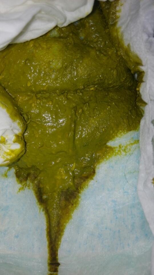 宝宝两个月了吃奶粉拉屎这个颜色很臭正常吗?