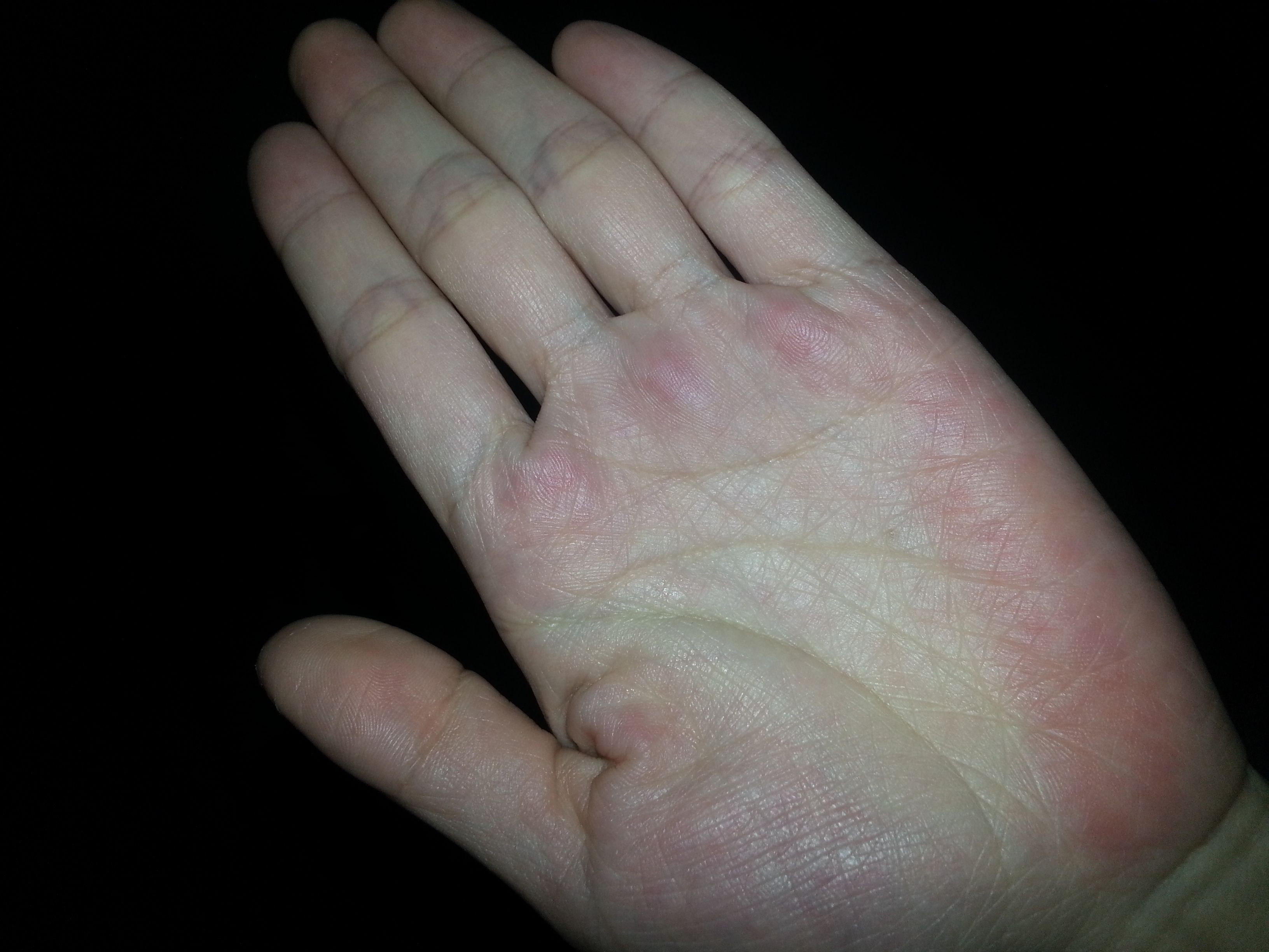 生完孩子发现手掌一直是红的,现在6个月了也是红红的,也不疼也不痒