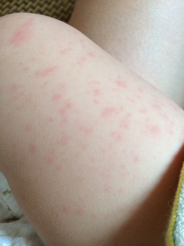 宝宝九个月大,之前出过幼儿急疹了,前几天感冒发烧,反复四五天,吃了