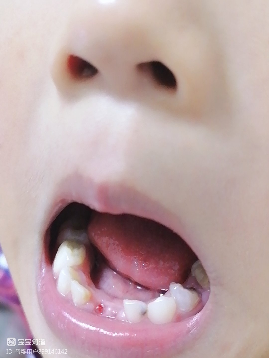 儿童乳牙患龋率高达70%！家长把握关键5招，有效降低孩子患龋率 - 知乎