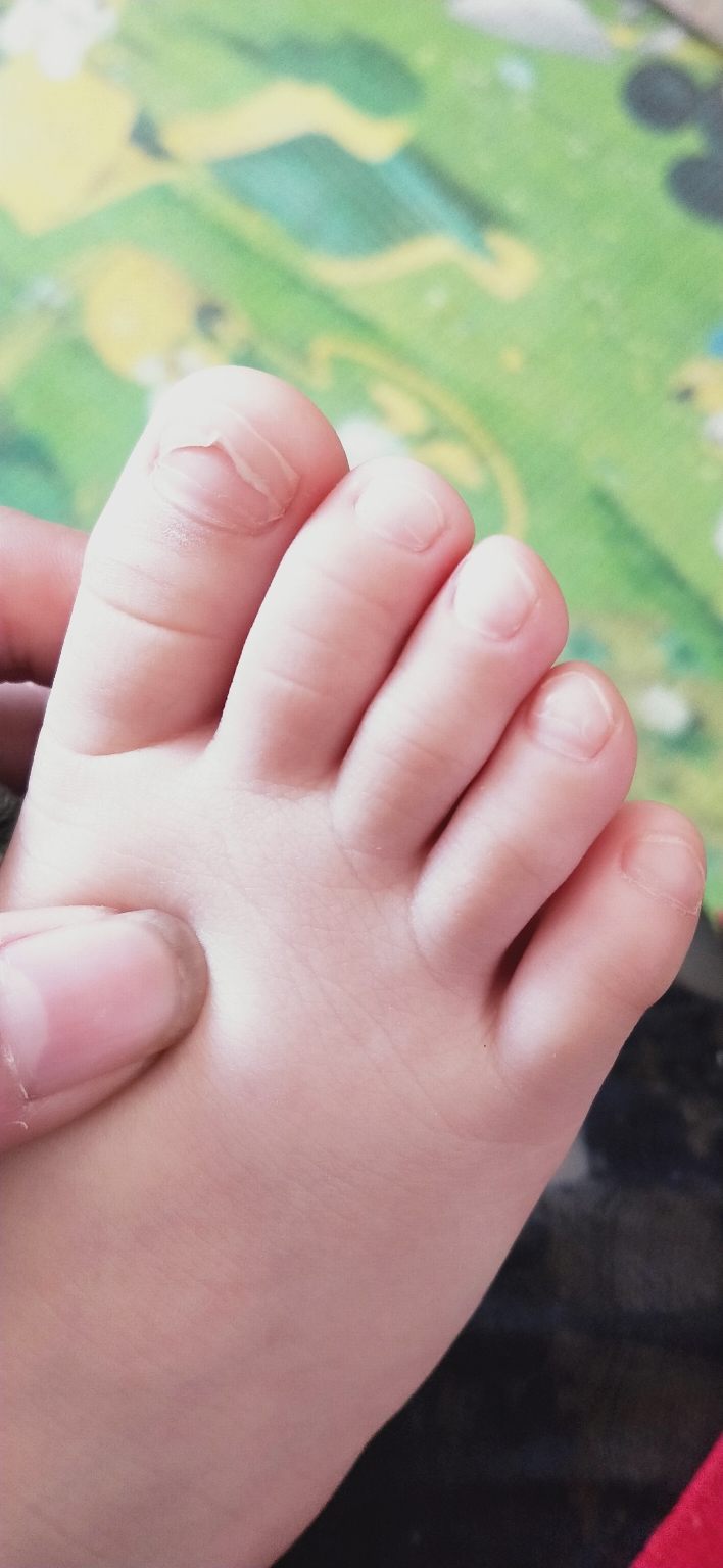 女儿3岁半,手和脚指甲都裂开脱掉怎么回事,有没有这样的宝宝