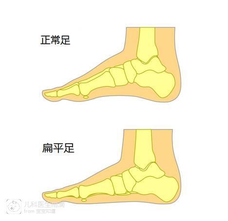 怎样判断宝宝是否有扁平足?该如何预防?
