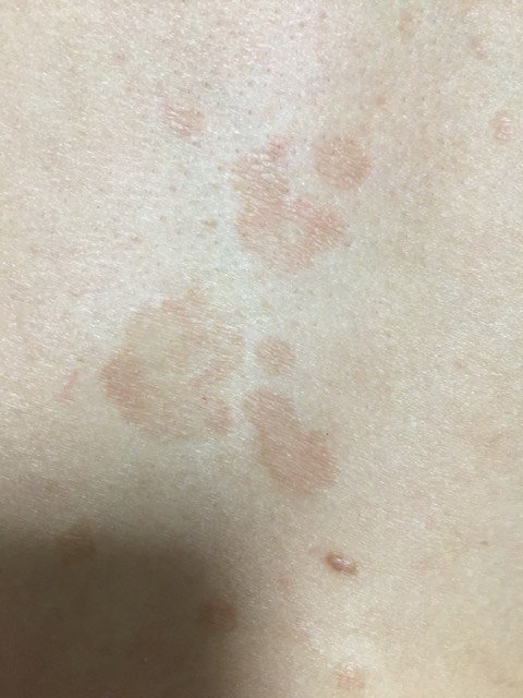 哪位医生能告诉我?老公身上的,是汗斑还是癣