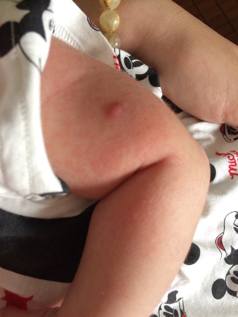 宝宝手臂起红疙瘩