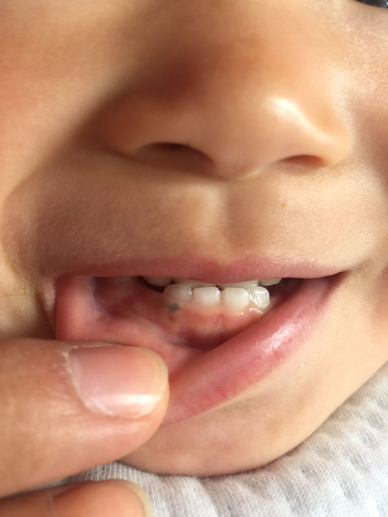 求鉴定,宝宝牙龈上黑了一块 之前以为是瘀血,可是一个礼拜过去了好像