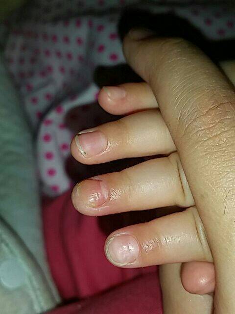 两边连肉的地方变短,指甲中间鼓起,前面平,两边变厚,甲根的肉有点红肿