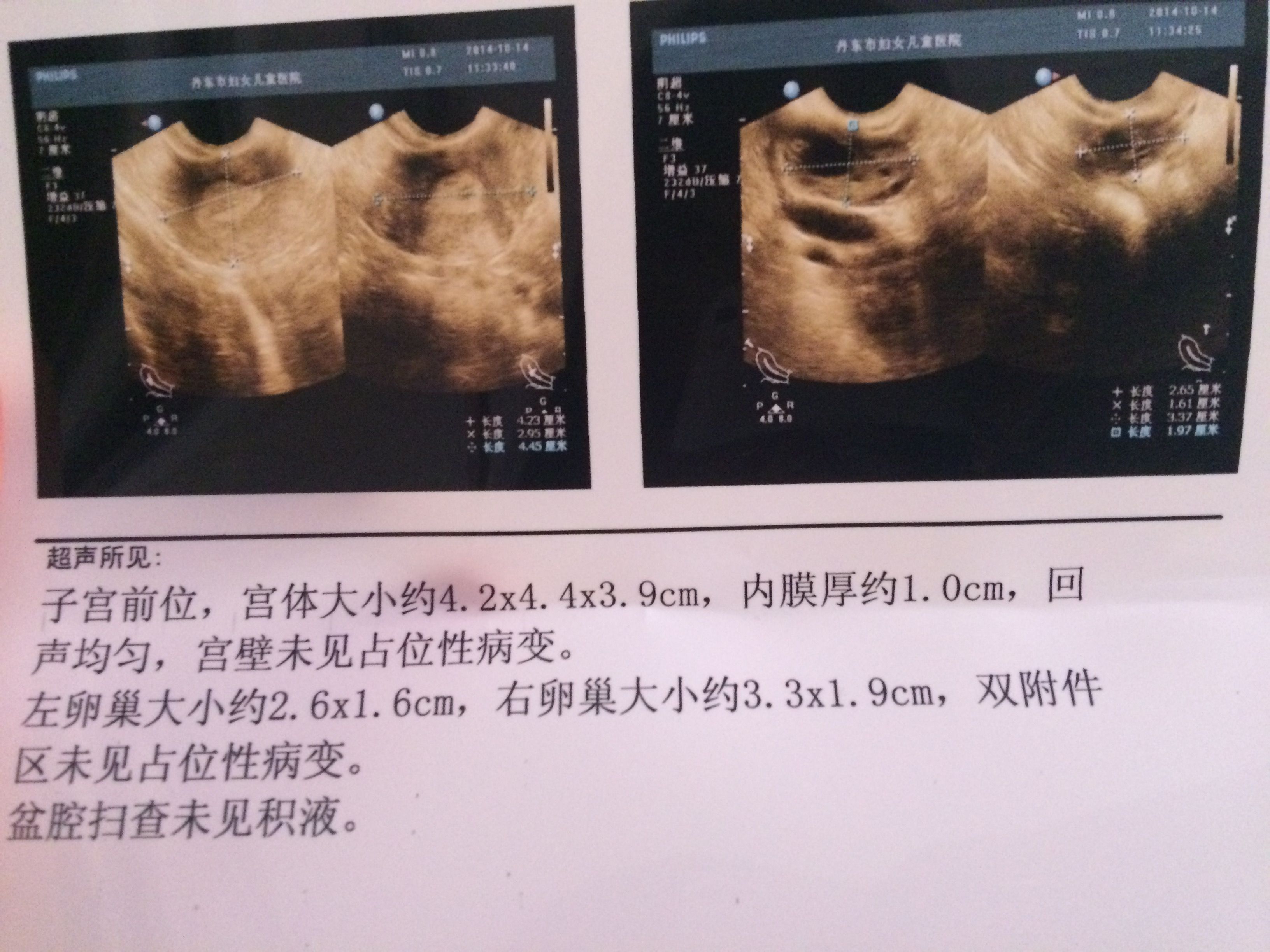 人流后29天阴式彩超结果