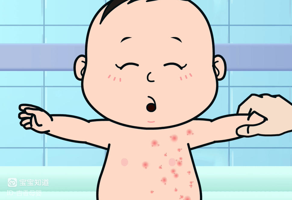 宝宝常见病系列病痱子