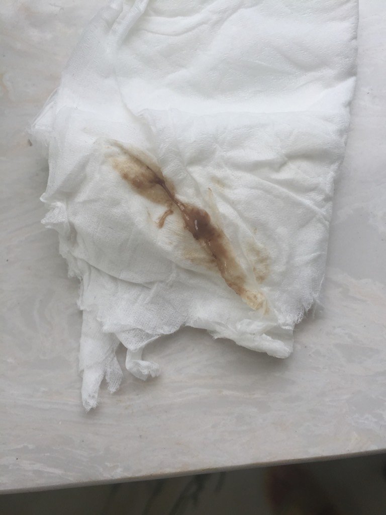 2,第53天小腹痛流黑褐色血开始就每天打孕酮针,希望宝宝是坚强的